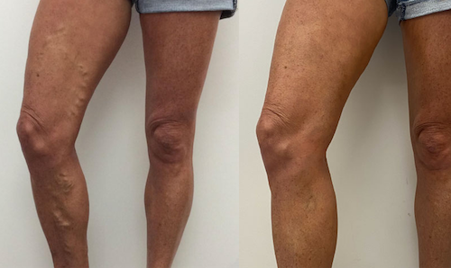 varicose vein treatment results oakville